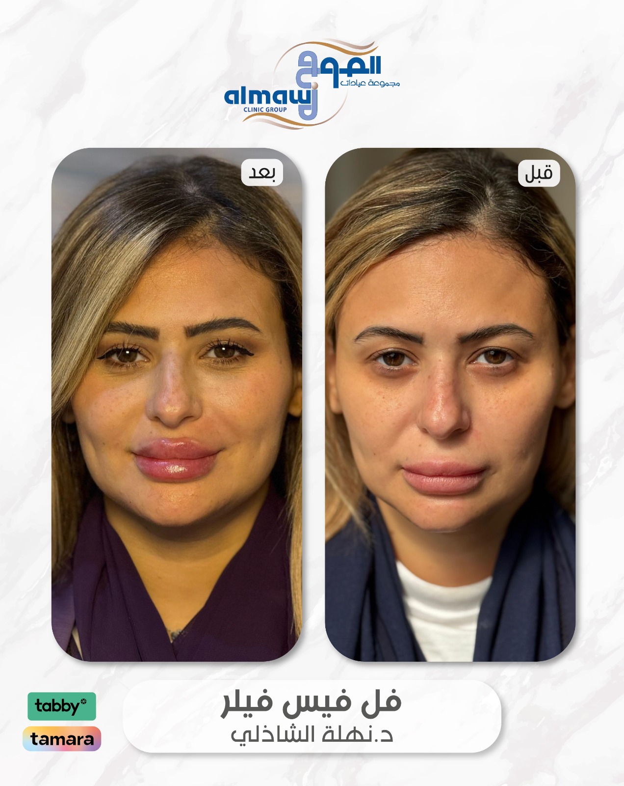 فل فيس فيلر د نهلة فرع الصفا