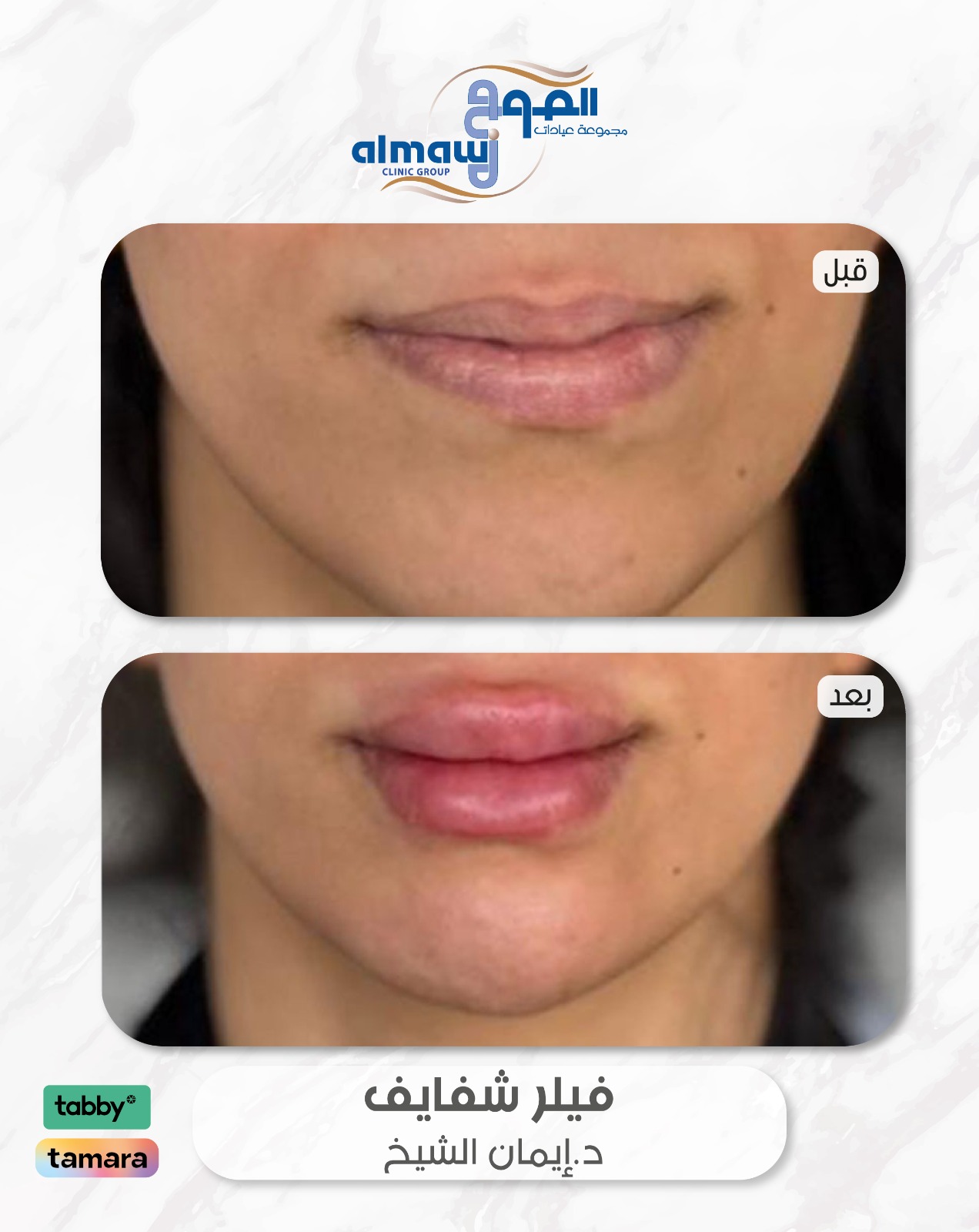 فيلر شفايف د ايمان الشيخ عيادات الموج فرع النهضة