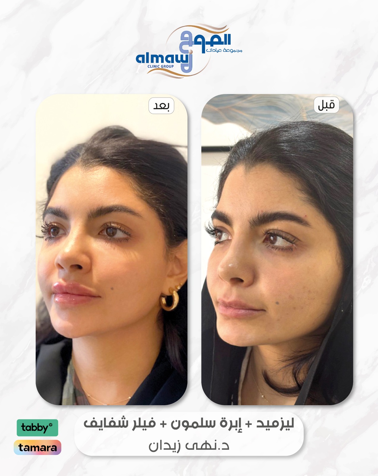 لزمد+ابرة سلمون+فيلر شفايف د نهى زيدان عيادات الموج فرع النهضة